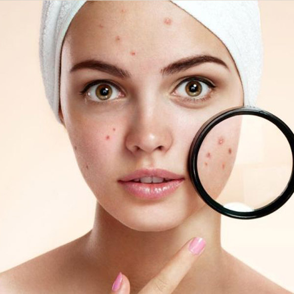 Female Acne Treatment