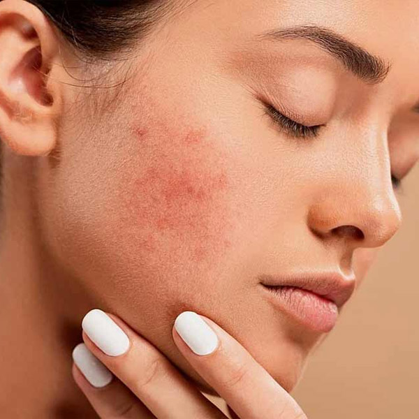 Female Face Acne Treatment